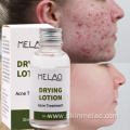 Drying Lotion Anti Acne Spot Treatment Serum